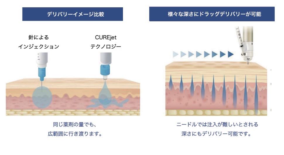 針による注入とCUREjetの比較