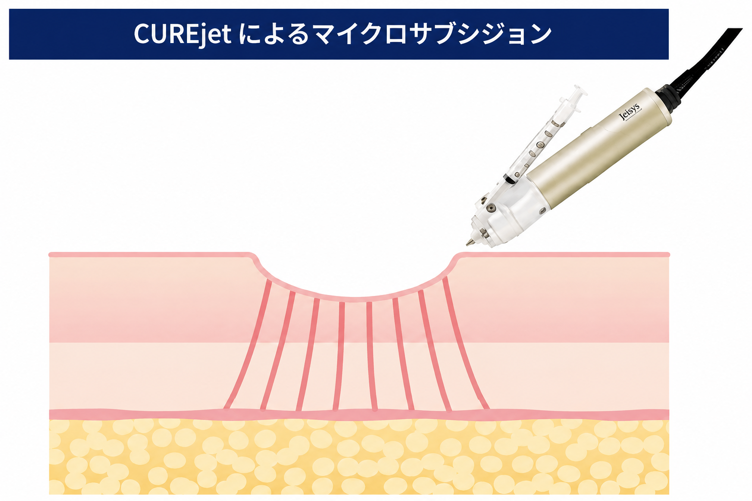 CUREjetによるマイクロサブシジョンのイメージ