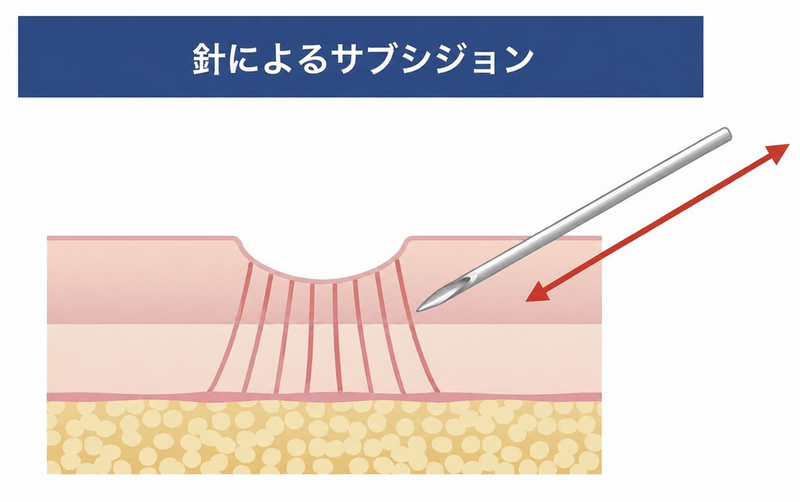 針によるサブシジョンのイメージ