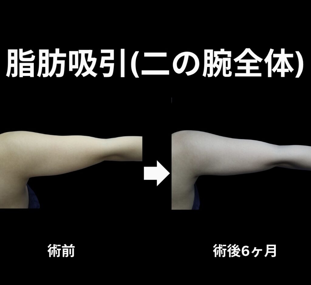 二の腕全体の脂肪吸引症例