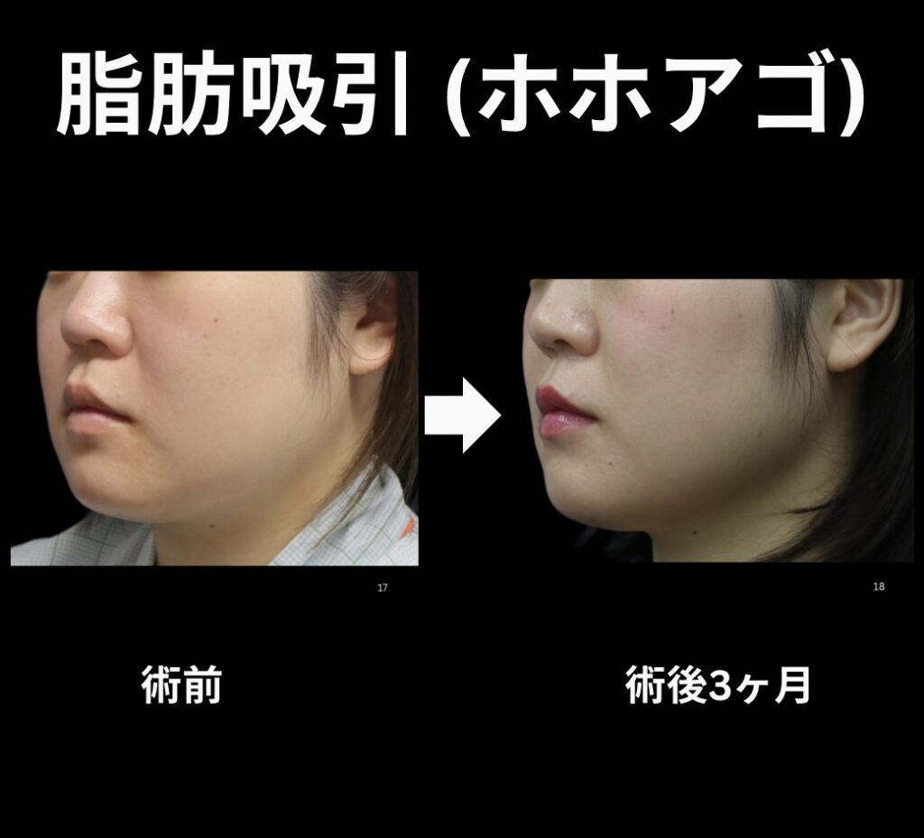 頬顎の脂肪吸引症例
