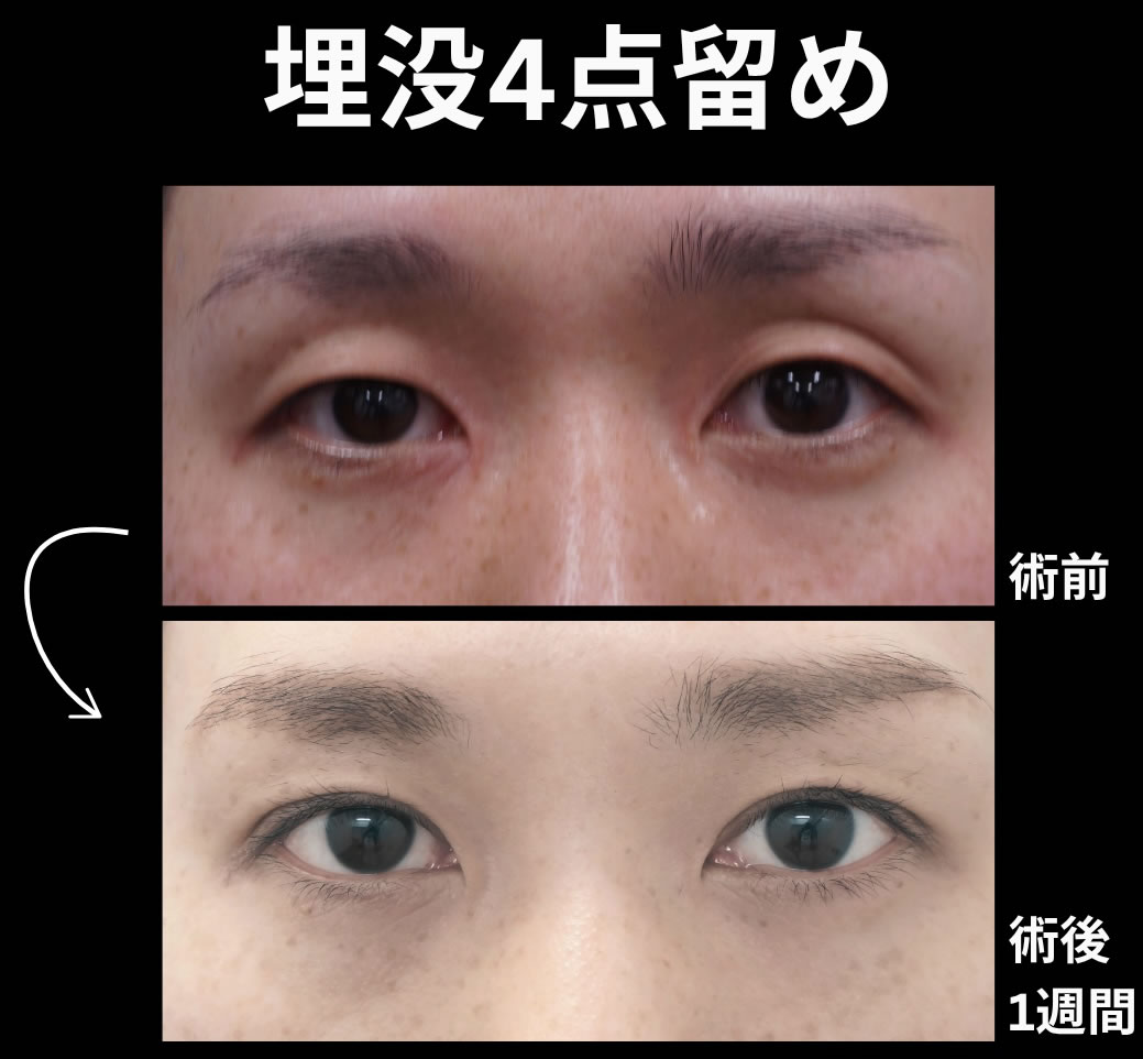 埋没法4点留め