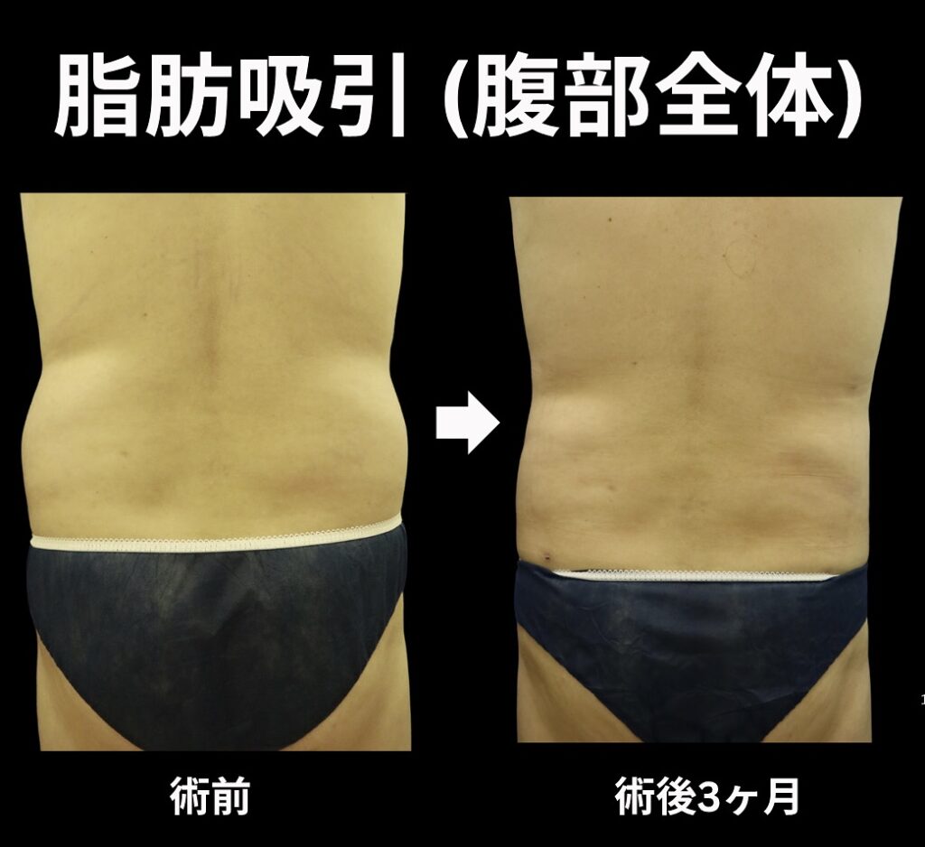 腹部全体の脂肪吸引症例