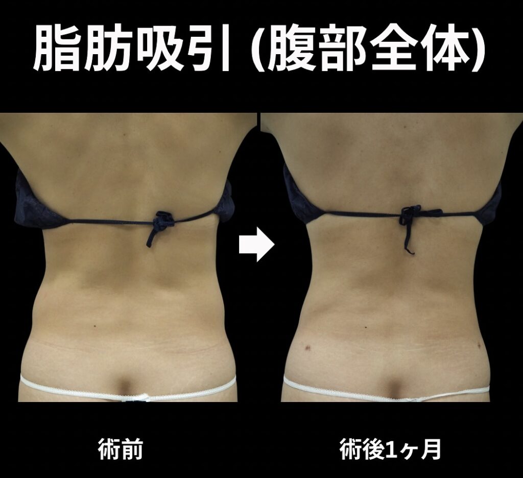 腹部全体の脂肪吸引