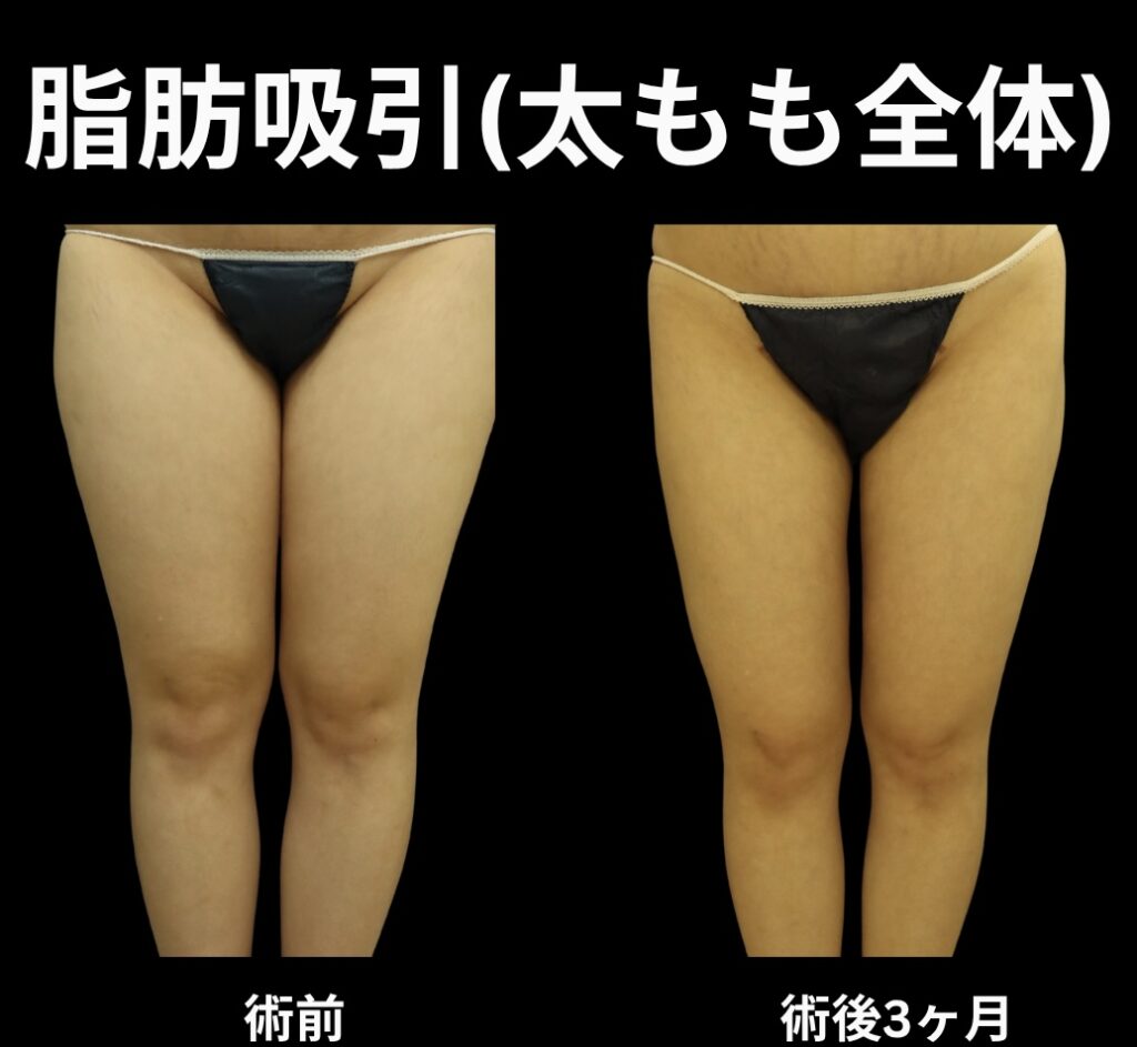 太もも全体の脂肪吸引症例