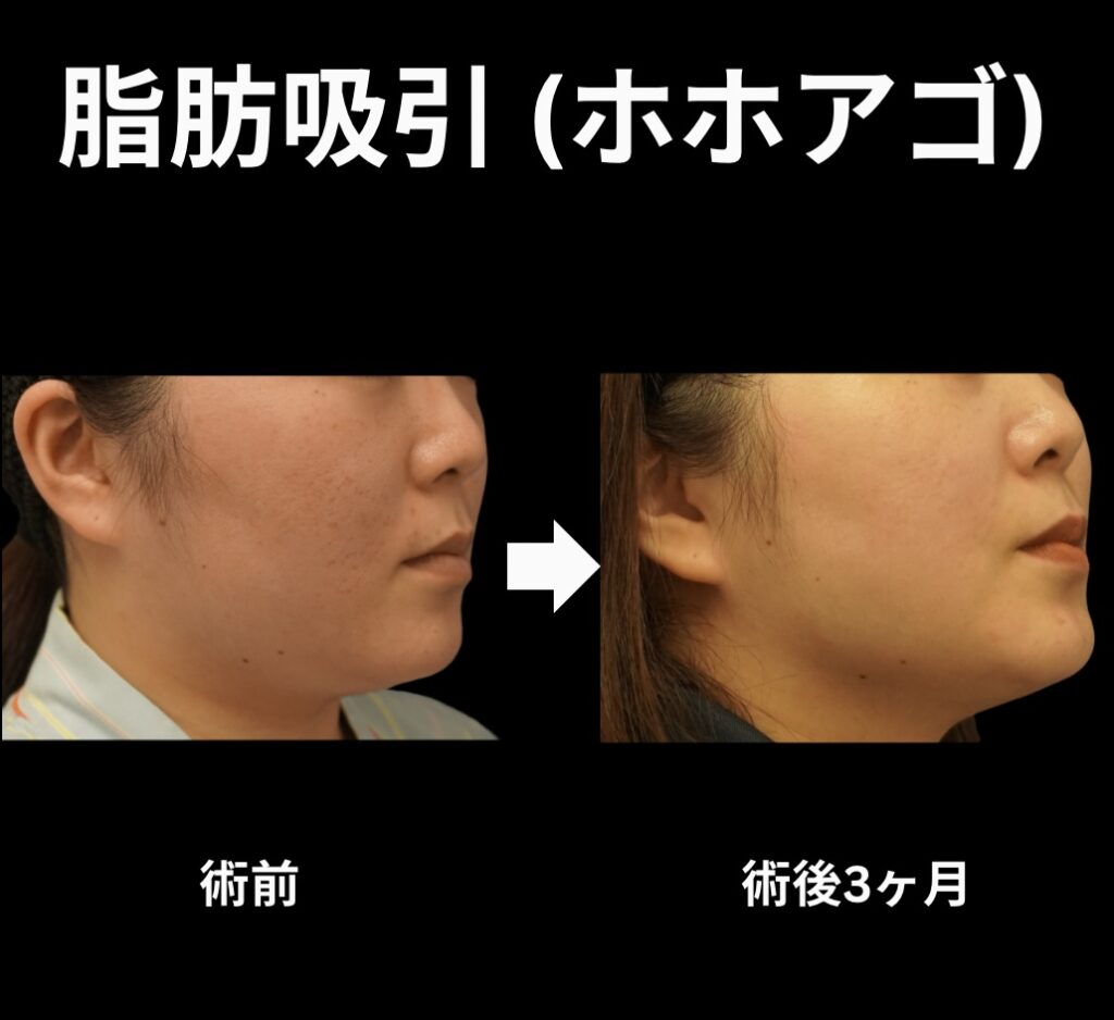 頬顎の脂肪吸引症例