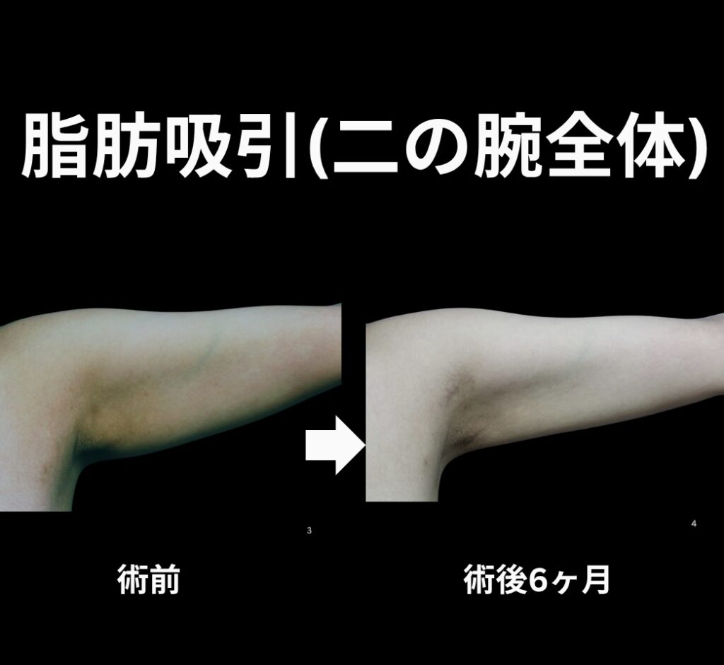 二の腕全体の脂肪吸引症例