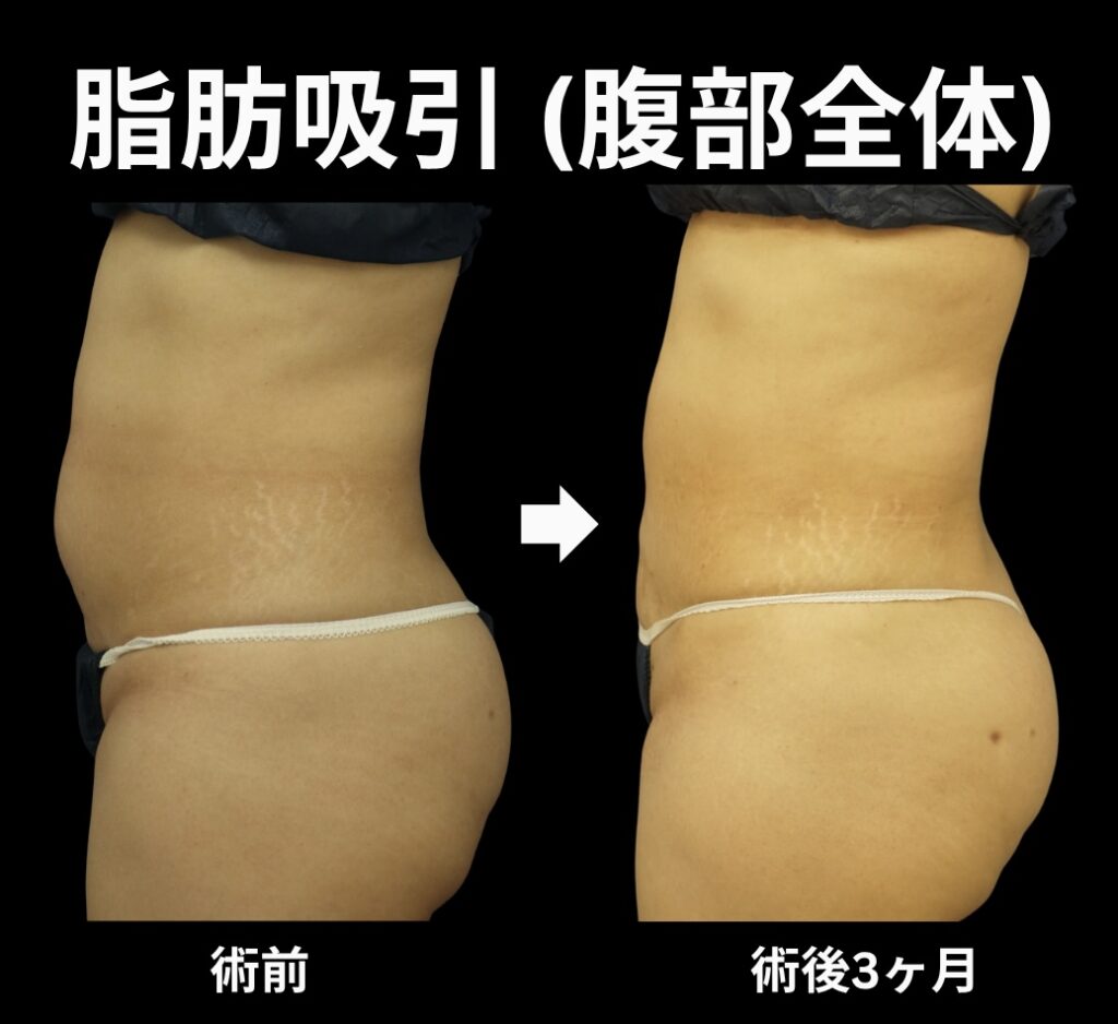 腹部全体の脂肪吸引症例