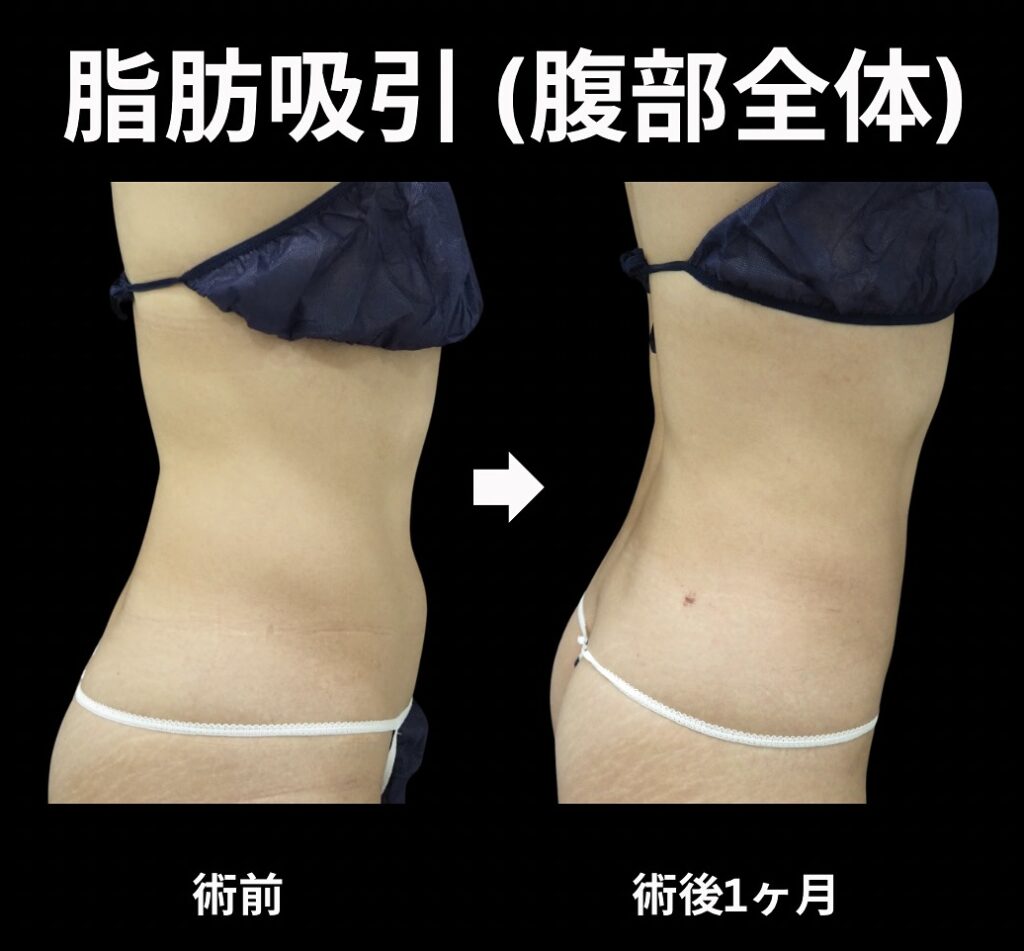 腹部全体の脂肪吸引