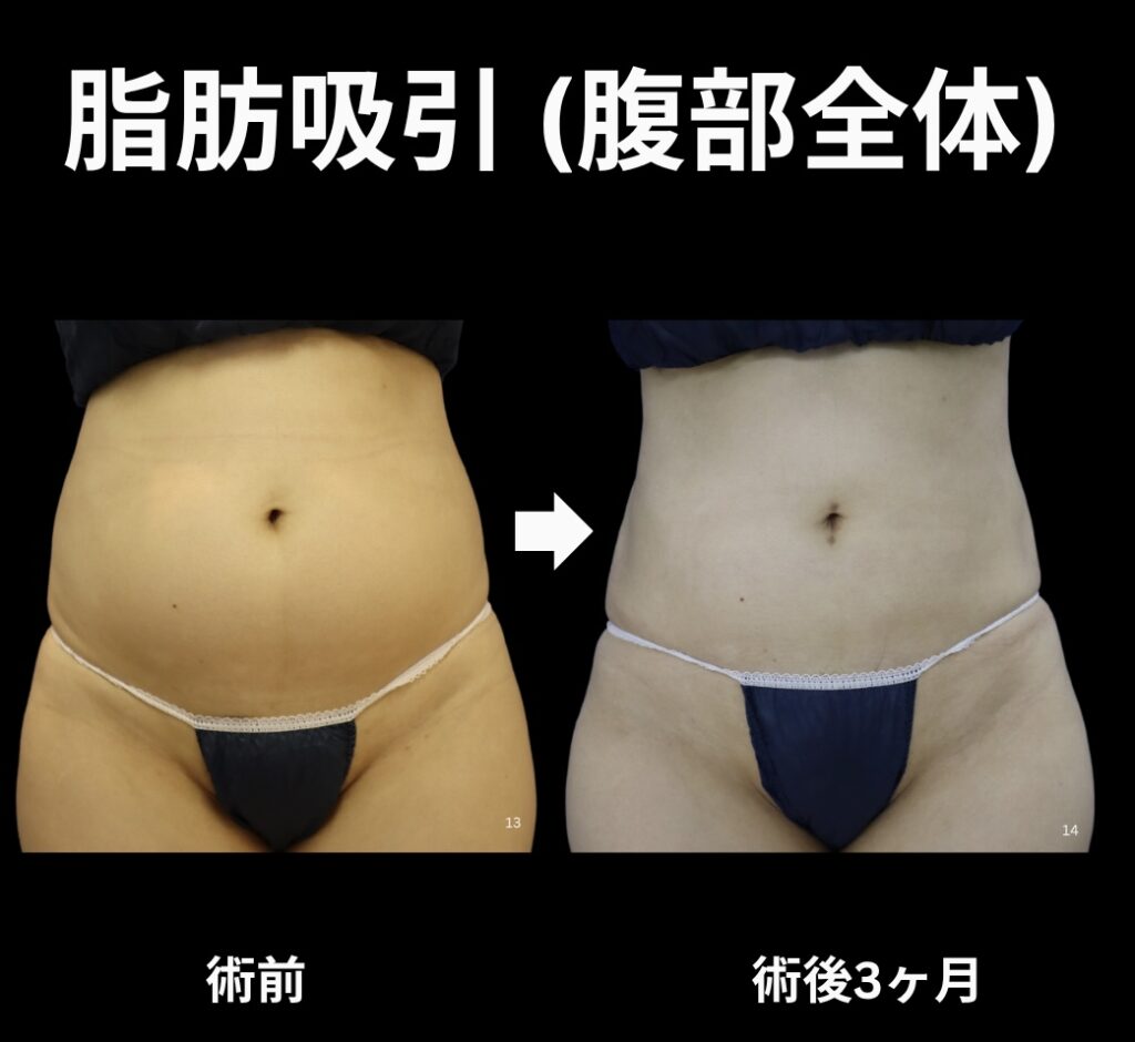 腹部全体の脂肪吸引症例