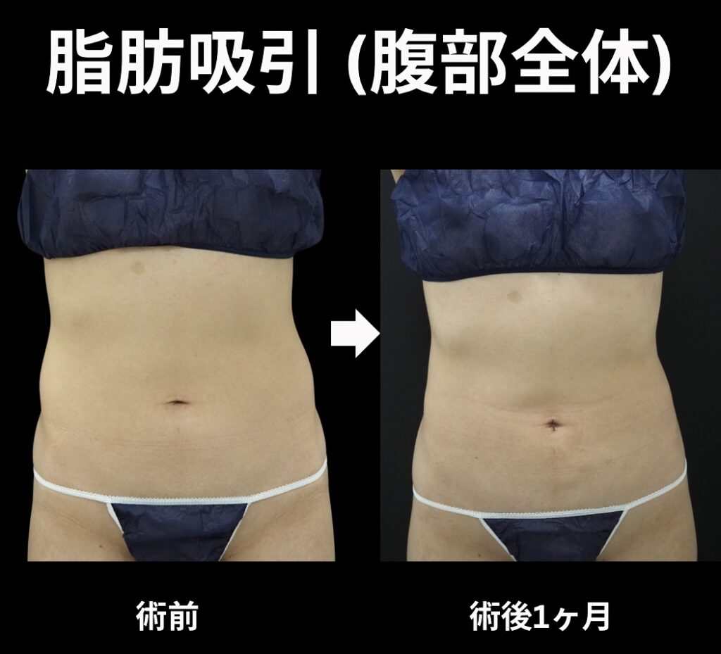 腹部全体の脂肪吸引
