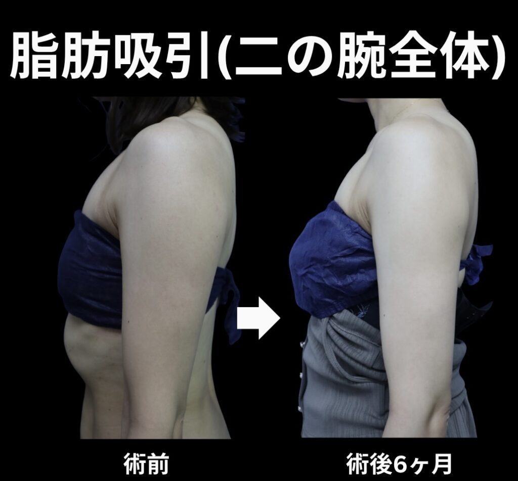二の腕全体の脂肪吸引症例