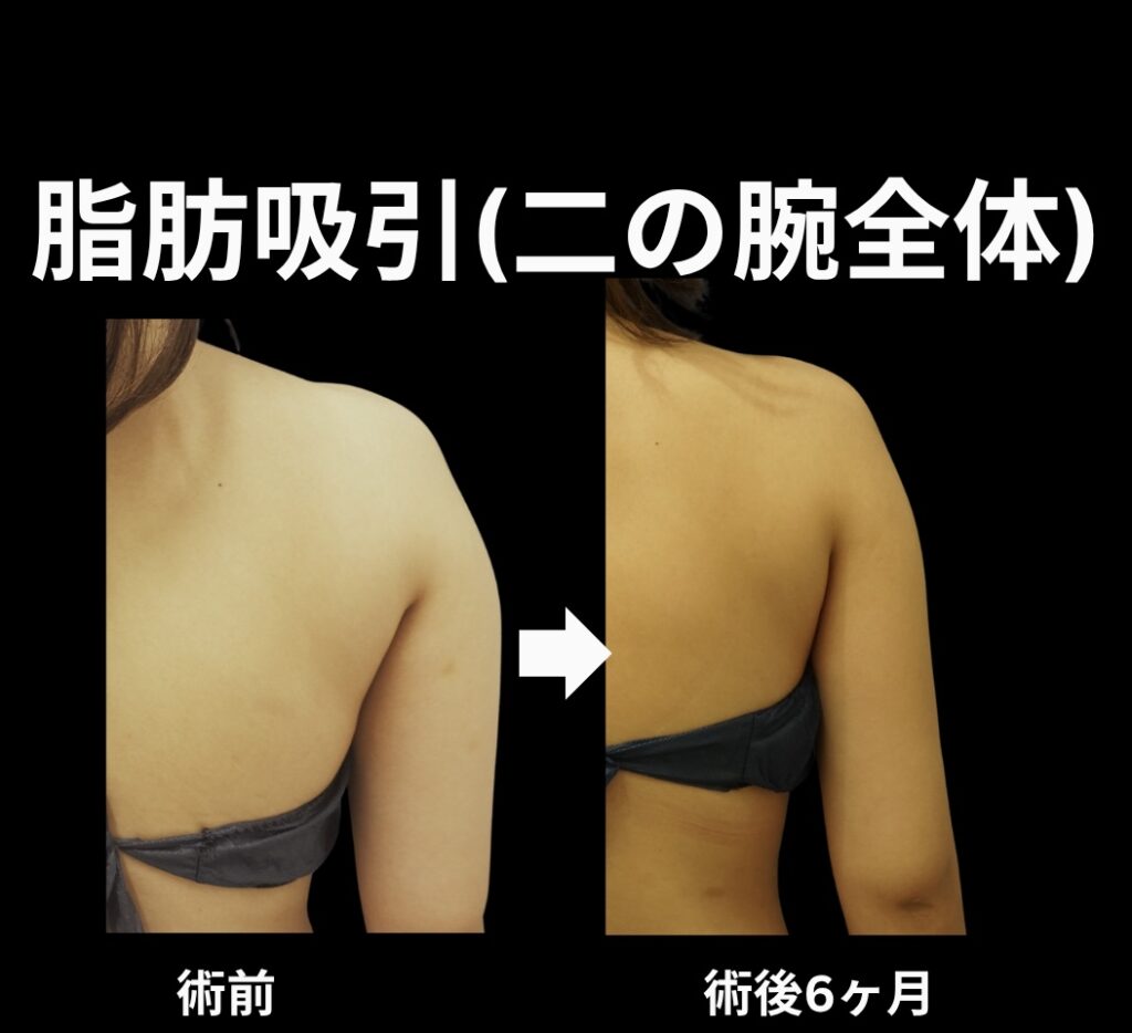 二の腕全体の脂肪吸引症例