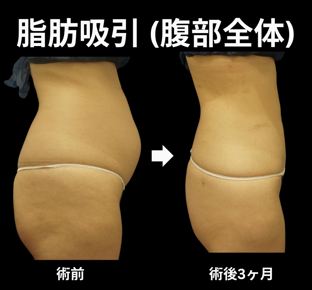 腹部全体の脂肪吸引症例