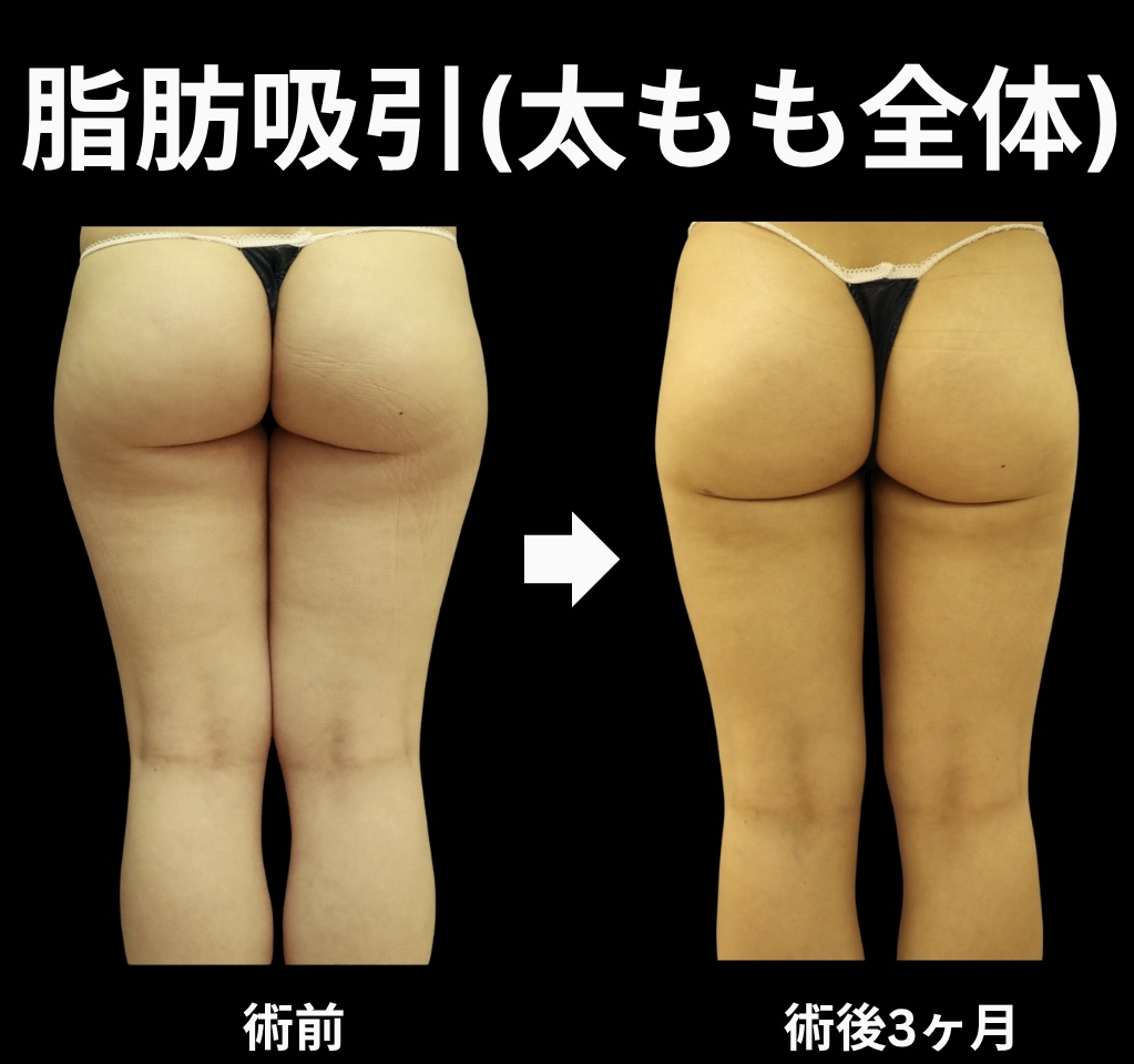 太もも全体の脂肪吸引症例
