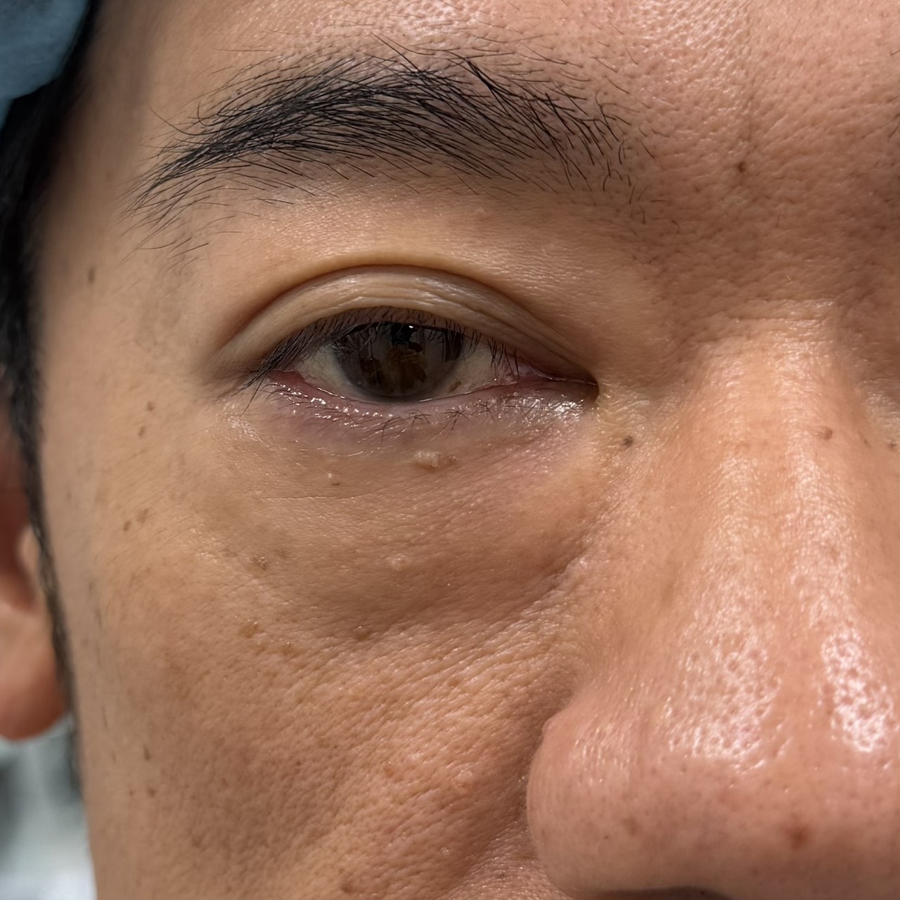下眼瞼の術前状態