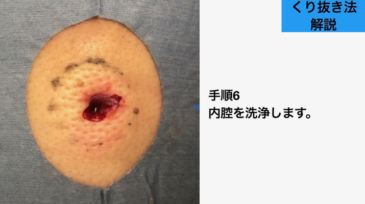 下北沢粉瘤日帰り手術