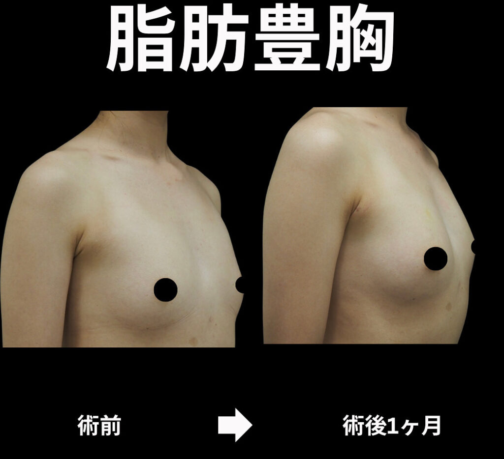 40歳女性・脂肪豊胸の症例写真