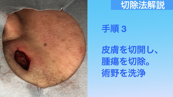 下北沢ほくろ切除