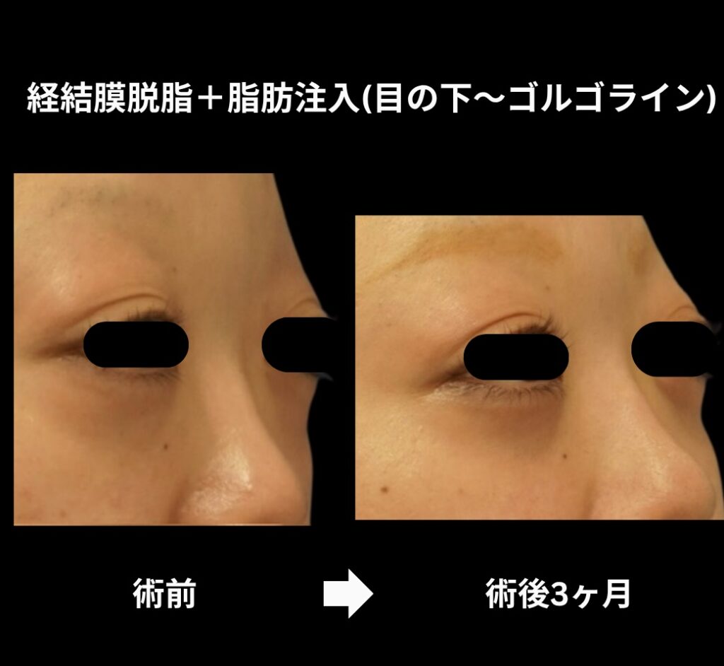 経結膜脱脂術+脂肪注入(目の下からゴルゴラインにかけて)の症例