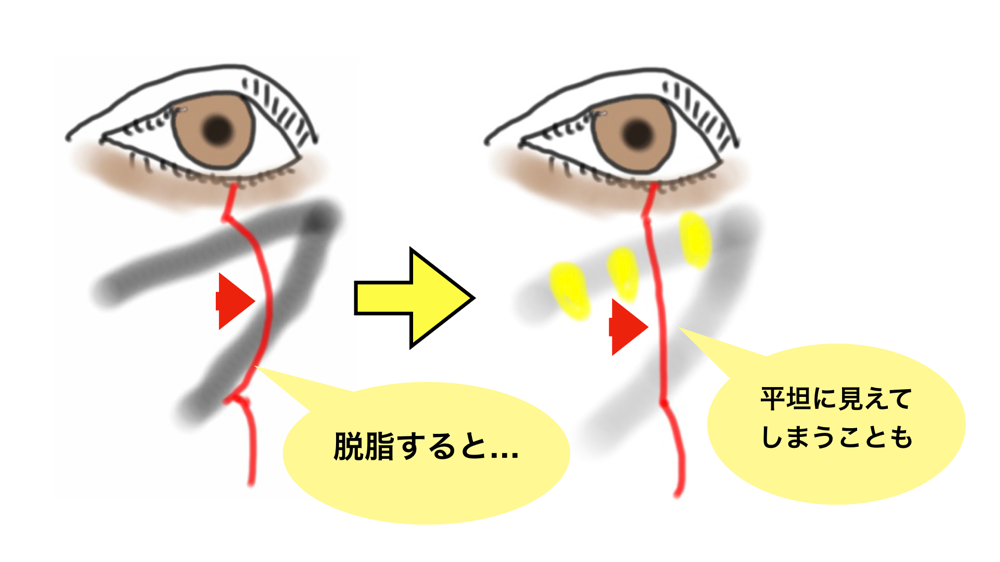 下眼瞼脱脂術のみでは不満足な理由