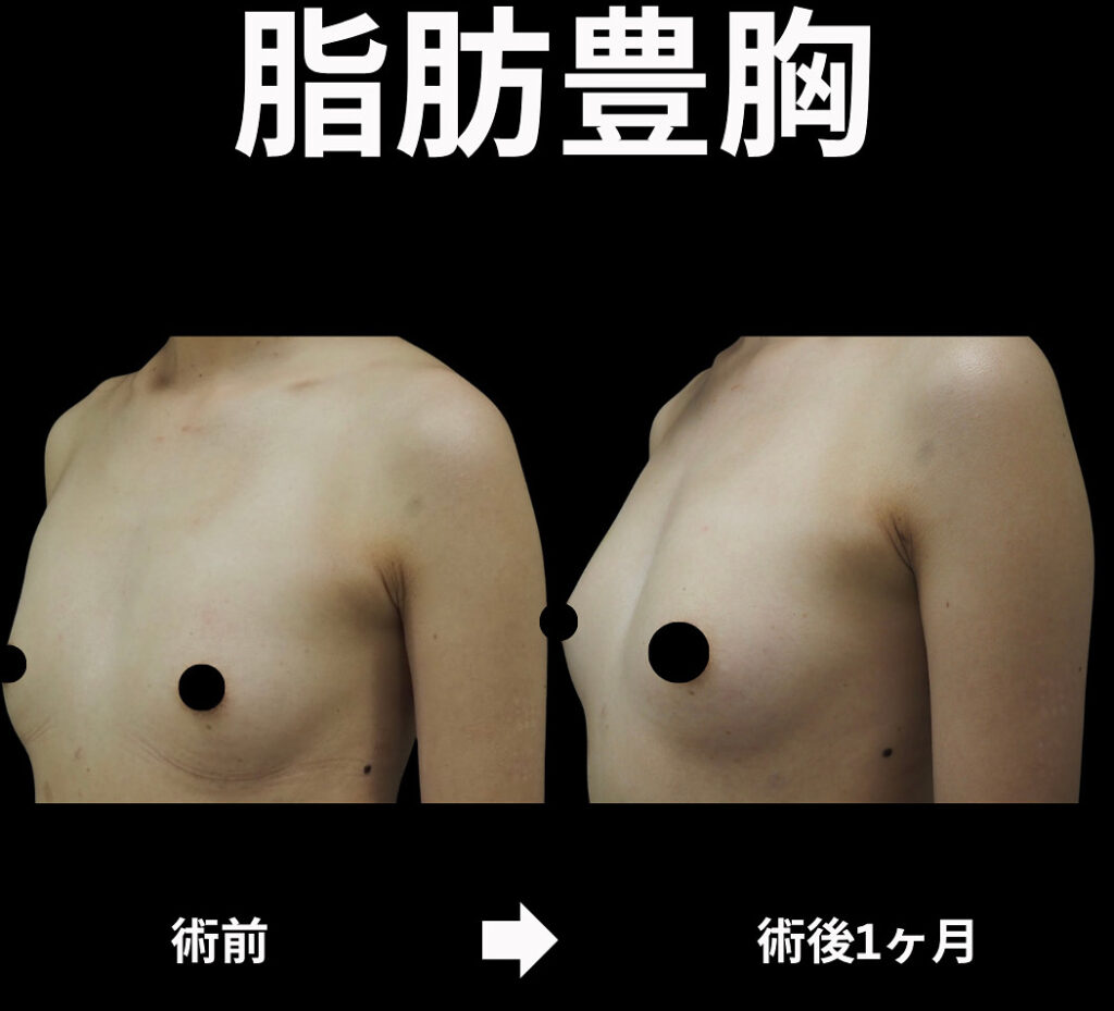 40歳女性・脂肪豊胸の症例写真