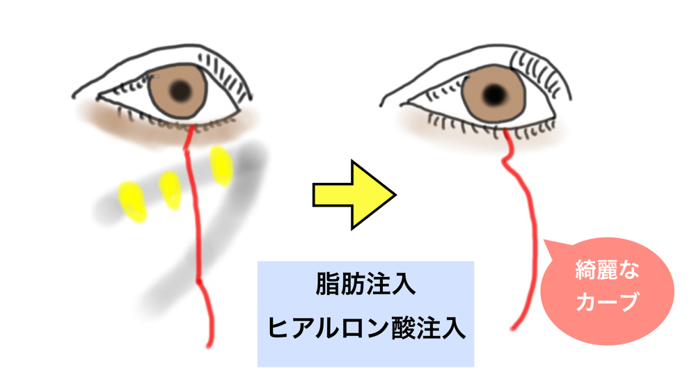下眼瞼脱脂後の注入について