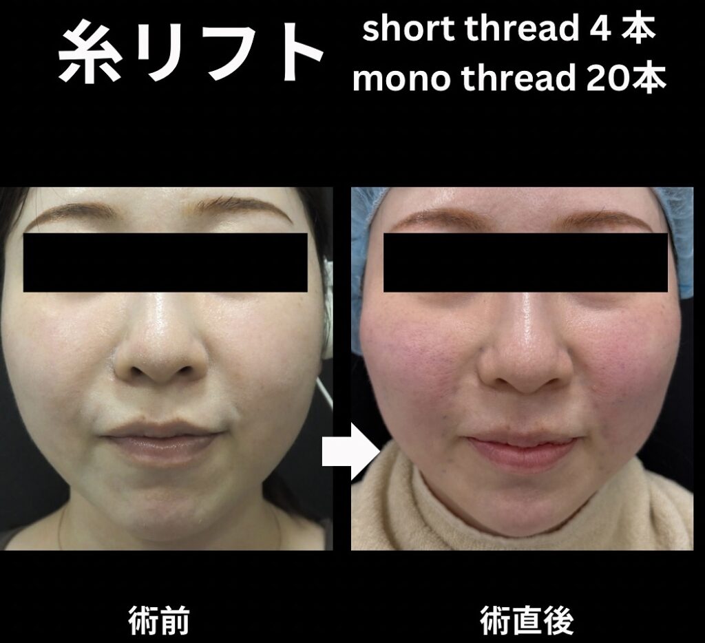 short thread4本とmono thread20本の症例
