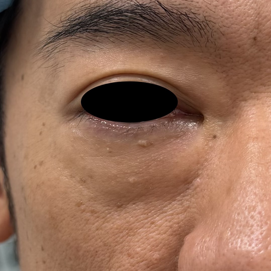 下眼瞼の術前状態