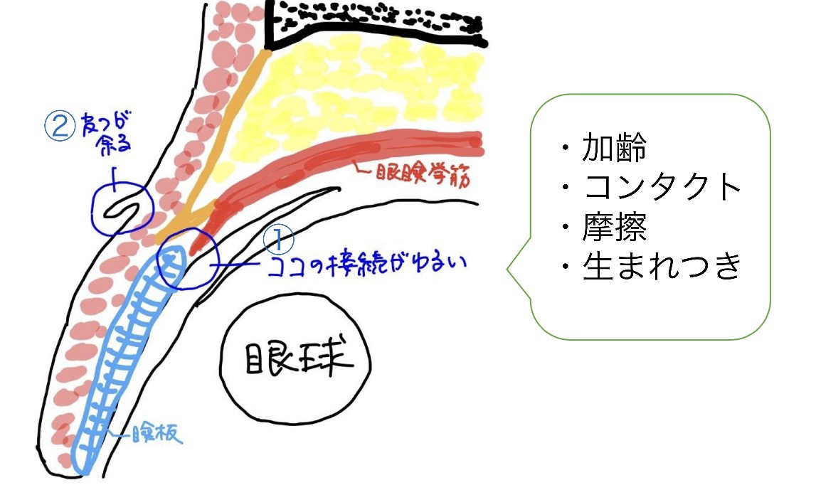 眼瞼下垂を起こす、主なメカニズム