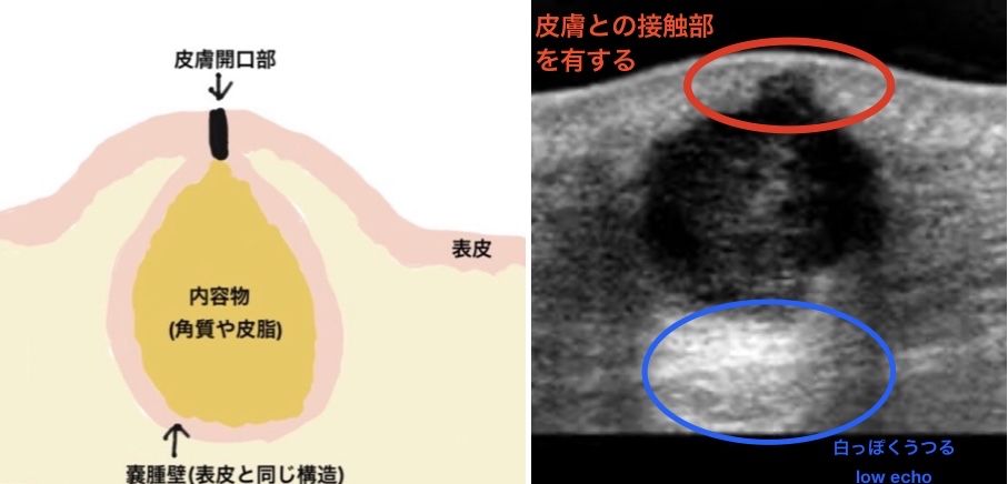 粉瘤の模式図、粉瘤の超音波所見