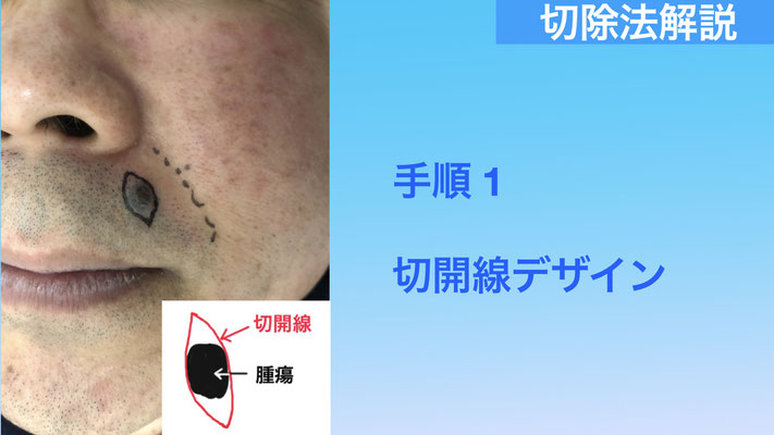 ホクロの切除法について解説
