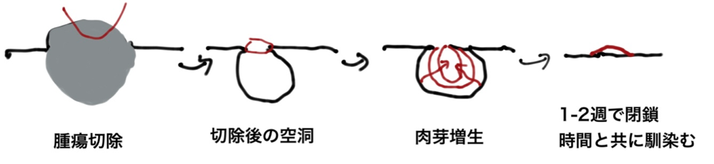 粉瘤切除後のイメージ図