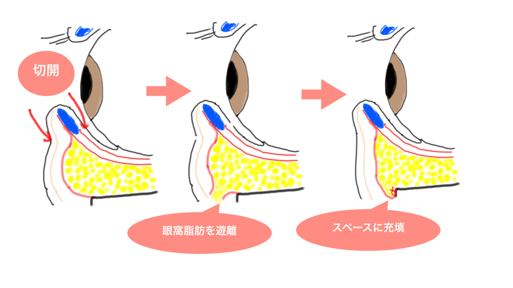 ハムラ法のイメージ図