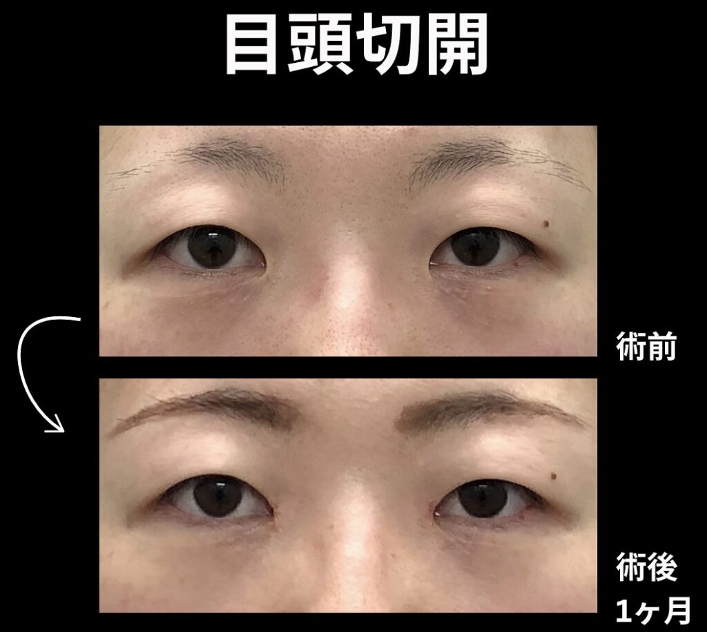 目頭切開の症例写真