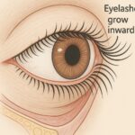 内反症 (逆さまつげ）に対する手術