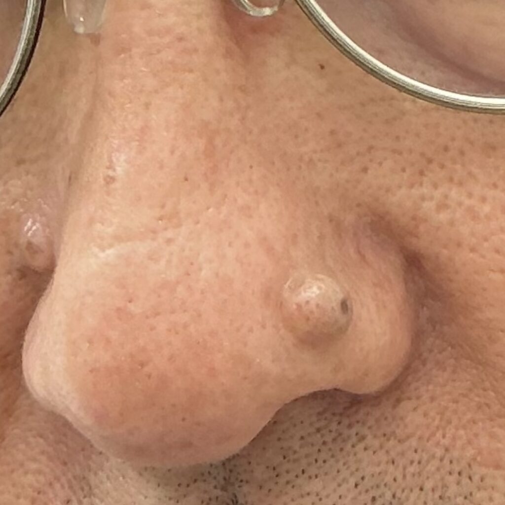 下北沢　良性腫瘍切除と局所皮弁作成術