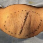 ワキガ手術 (皮弁法)