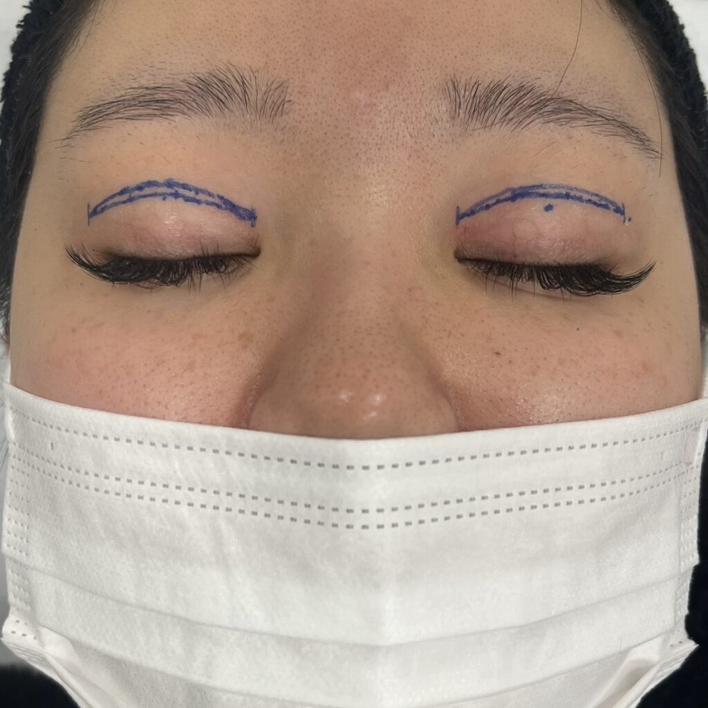 全切開術のデザイン