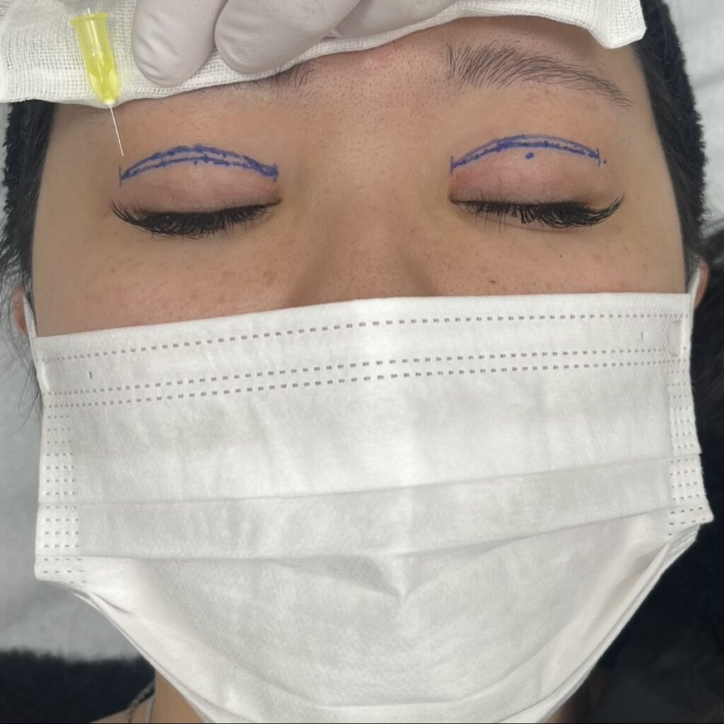 全切開術の局所麻酔