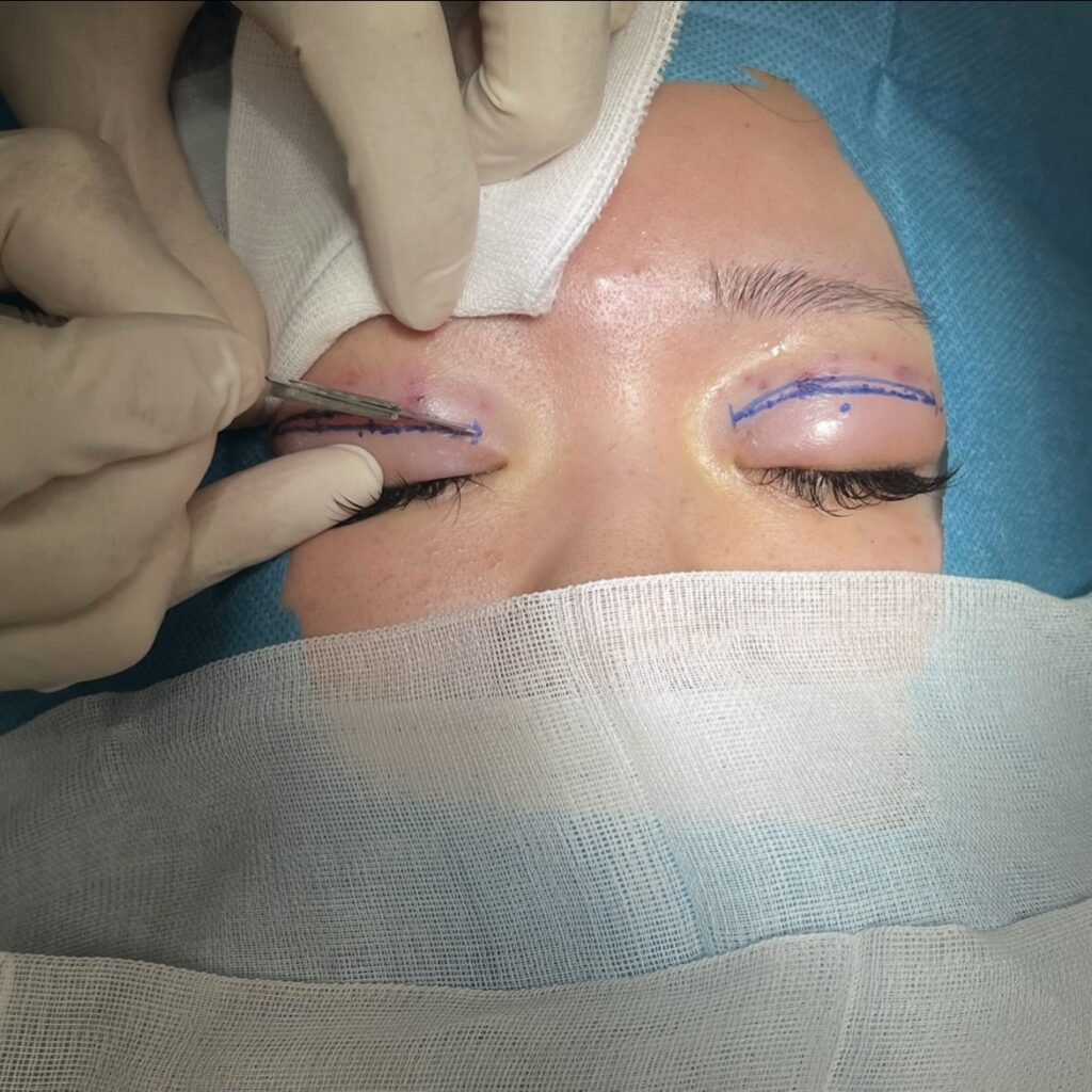 全切開術の皮膚切開