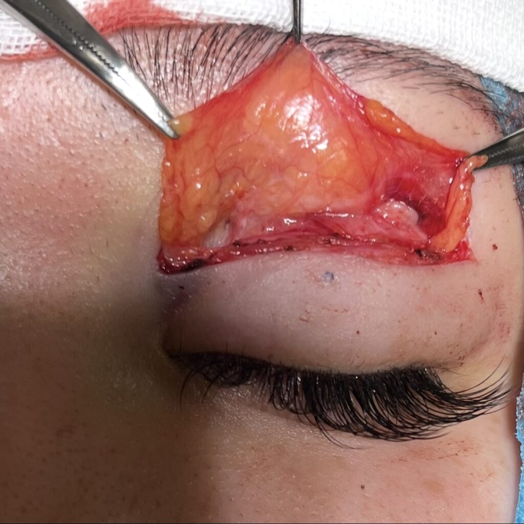 全切開術での、眼窩隔膜の同定