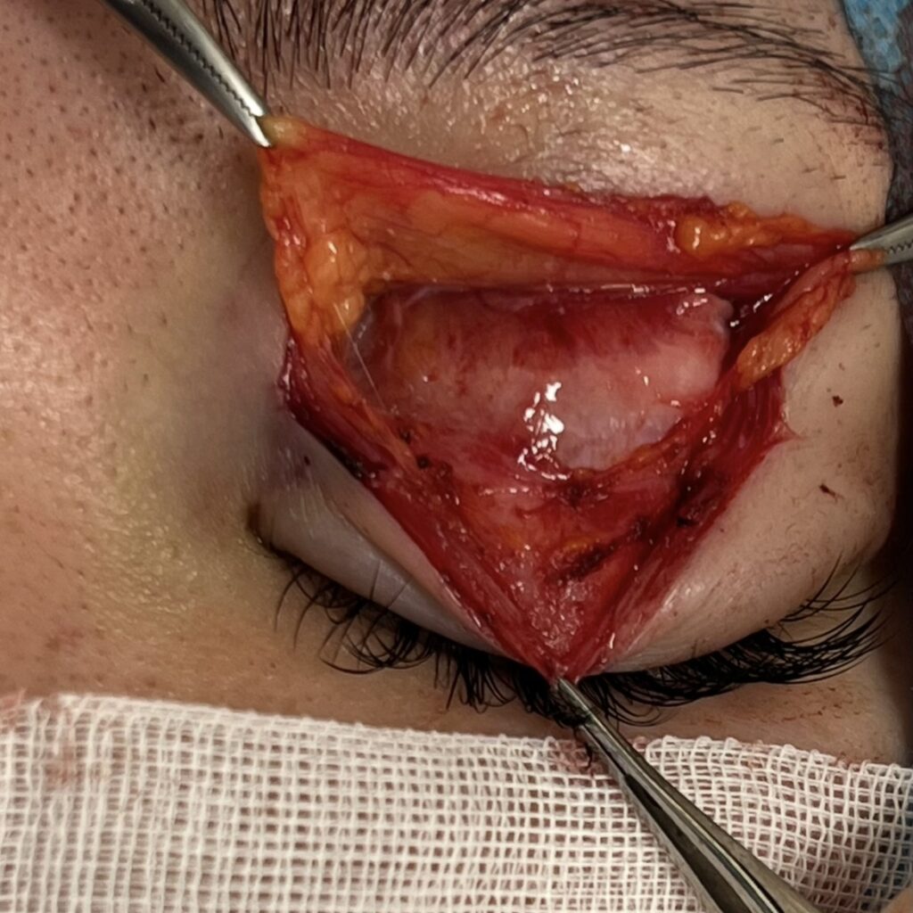 全切開術での、挙筋腱膜の同定