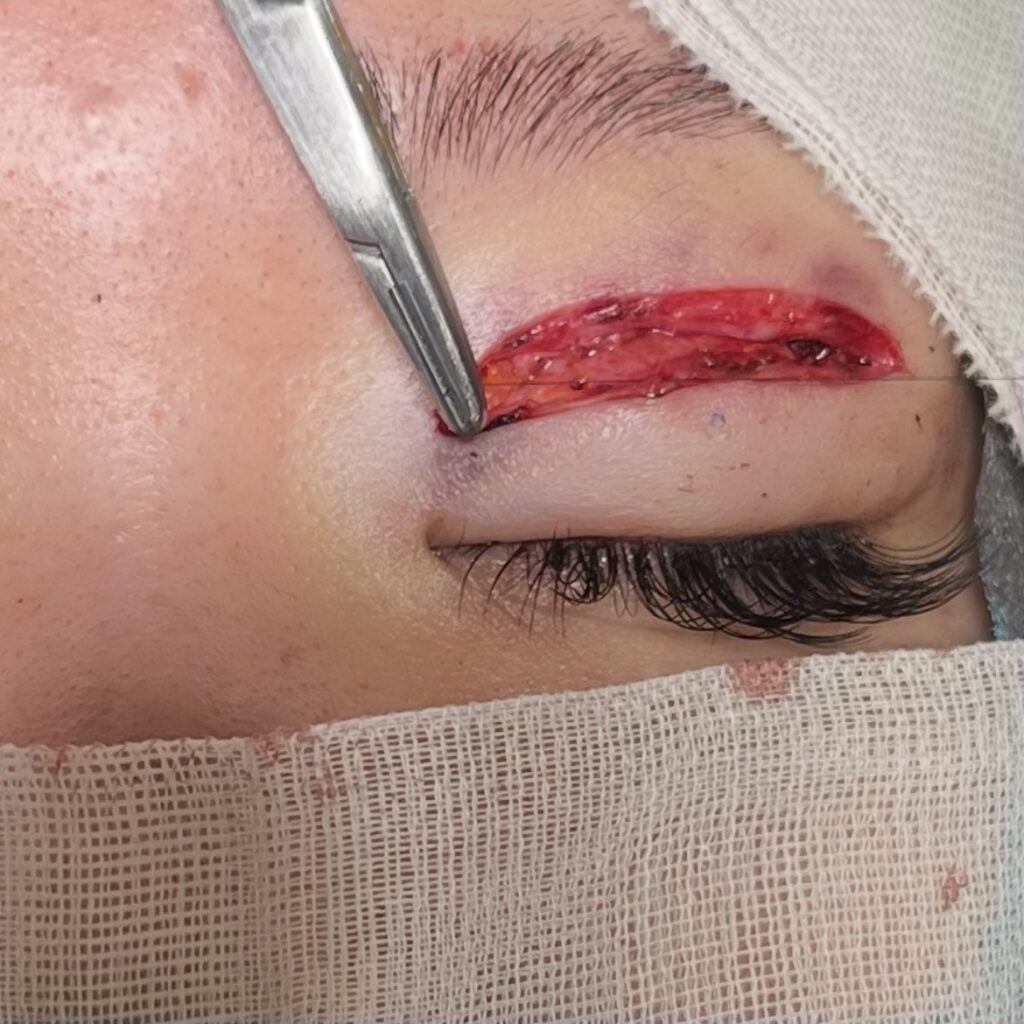 全切開術における縫合閉鎖