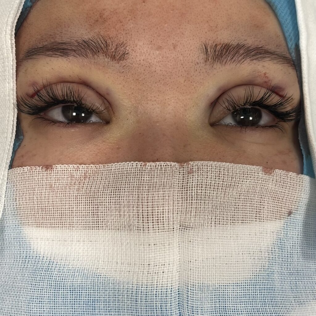 全切開術の術直後画像