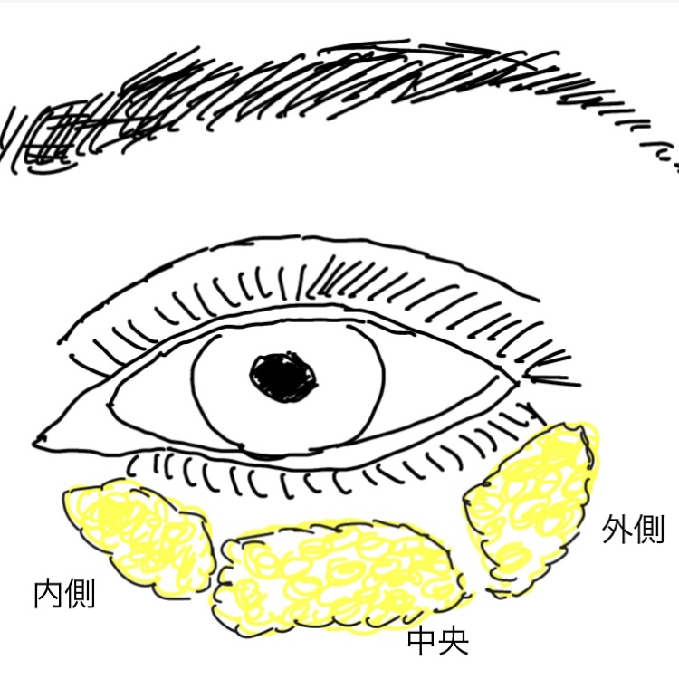 下眼瞼に存在する、眼窩脂肪。
