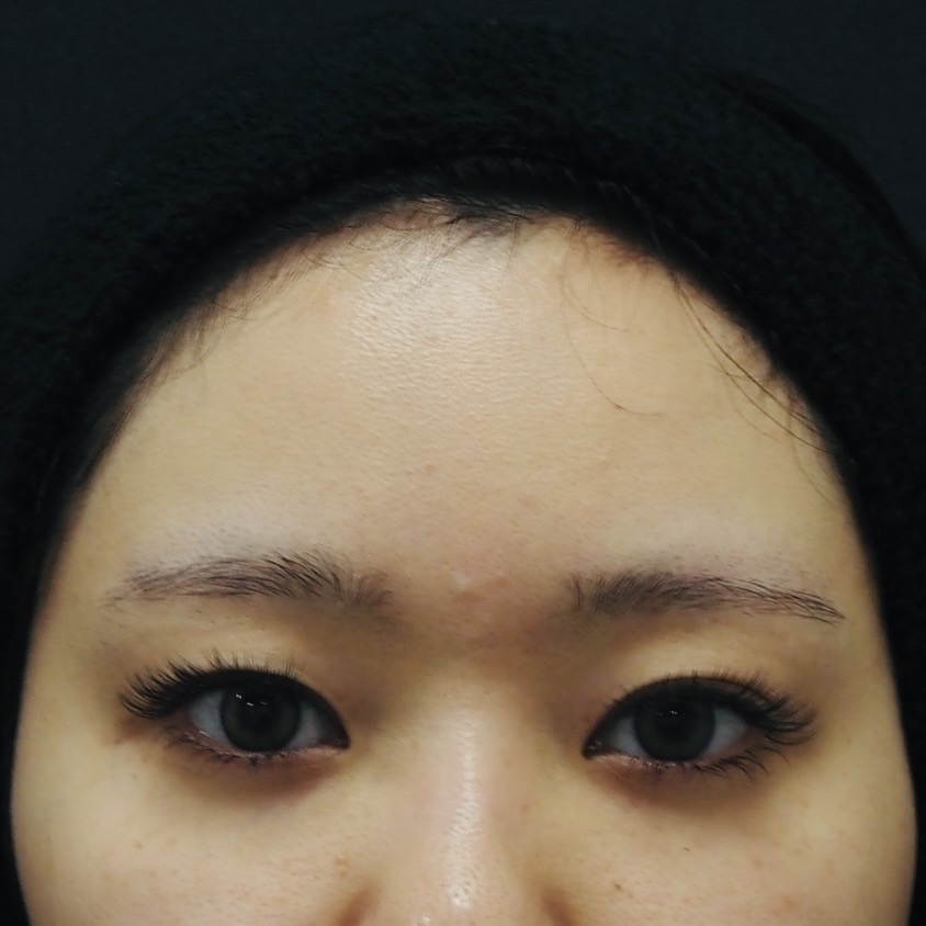 全切開術の術前画像