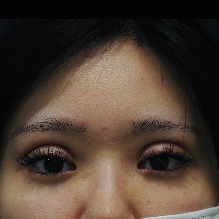 全切開術の術後１週間画像