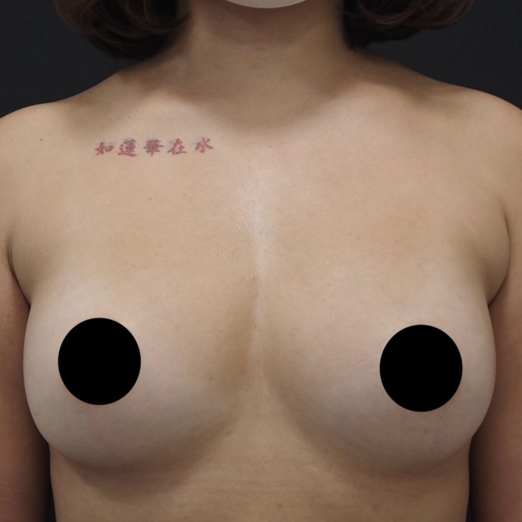 脂肪豊胸の術後１ヶ月画像