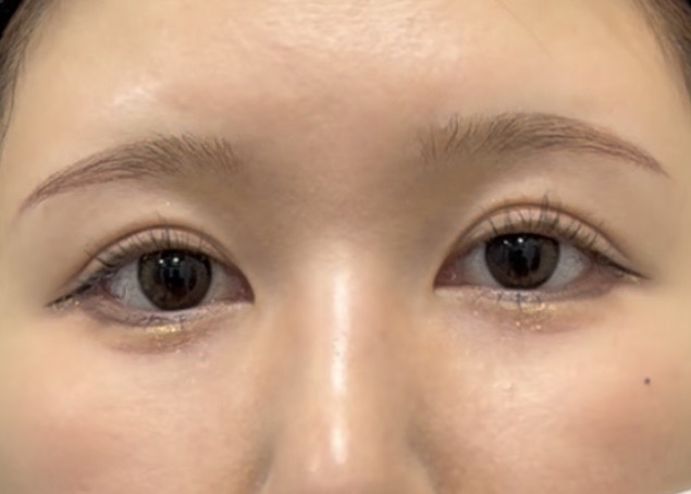 グラマラスライン＋目尻切開の術後１ヶ月写真